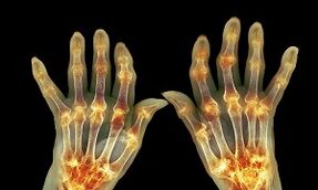 Qual è la differenza tra artrite dall'artrosi delle articolazioni