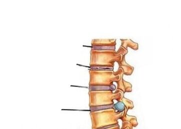 Quattro fasi di sviluppo dell'osteocondosi